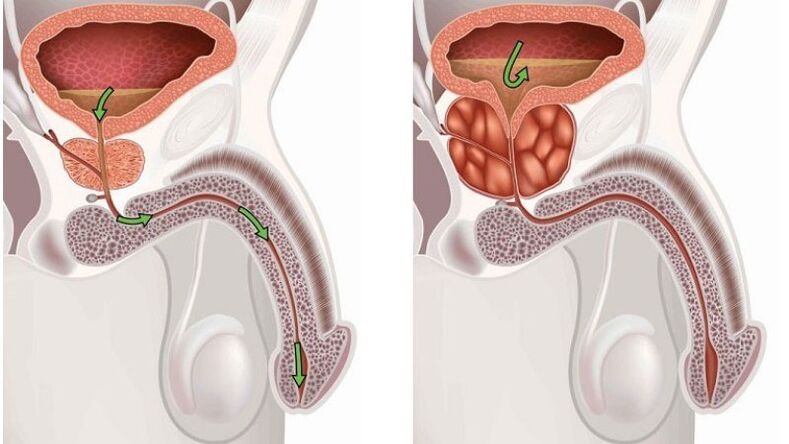 healthy and inflamed prostate with prostatitis